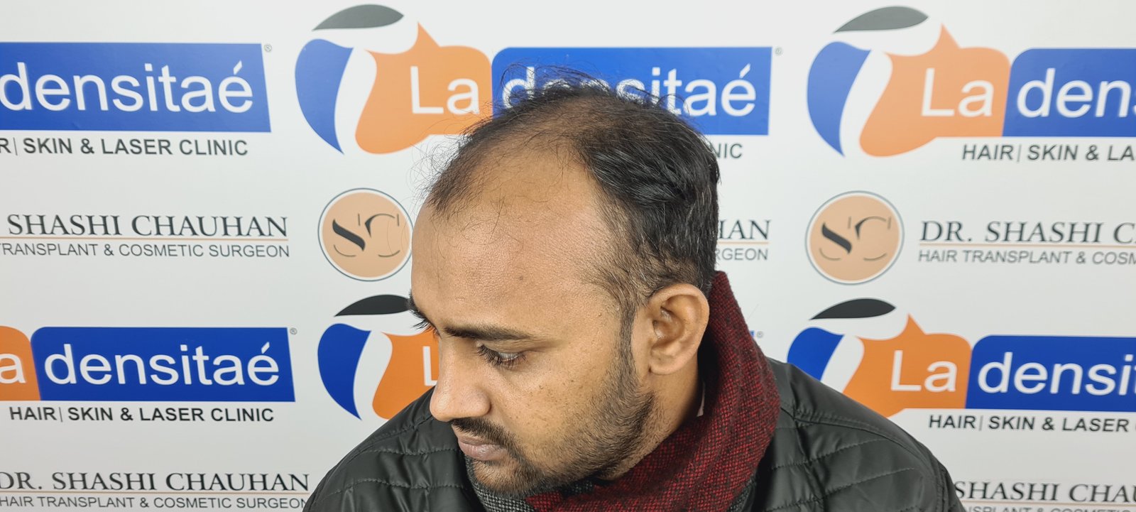 Abhay Pratap Yadav Before Hair Transplant